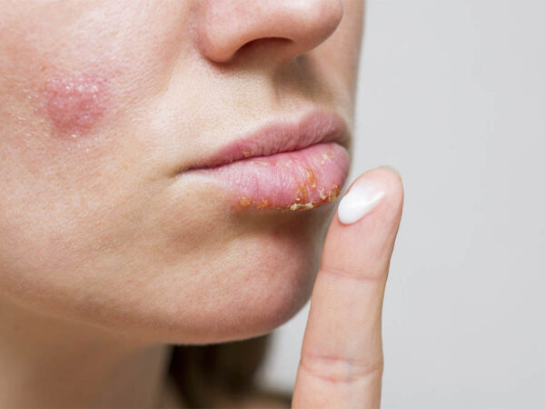 11-ways-how-to-avoid-cold-sores-this-winter-fashion-ie-2023